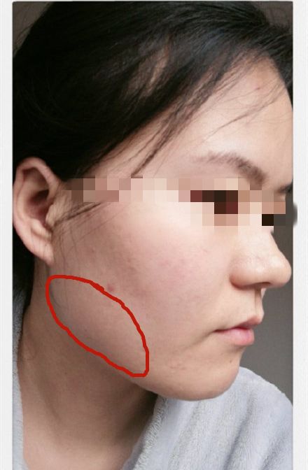 如何让咬肌自然变小(如何让咬肌自然变小不打瘦脸针)