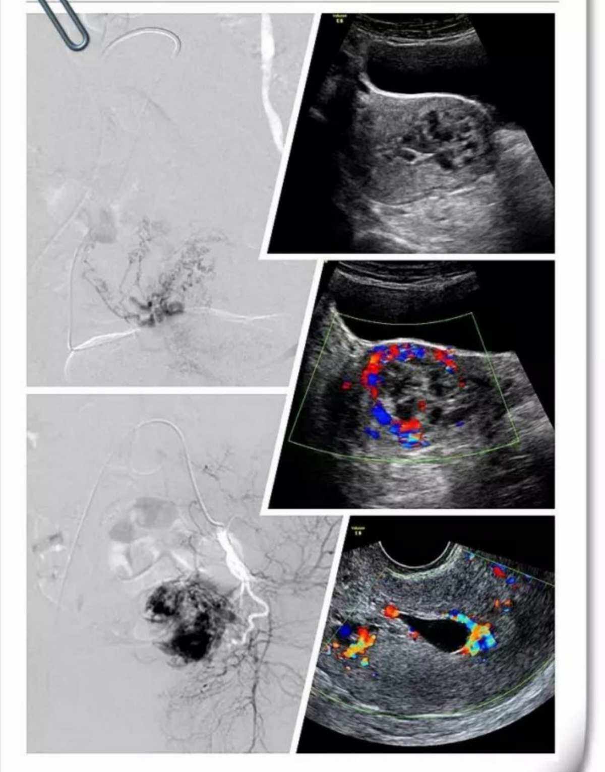 宫内妊娠(宫内妊娠囊样回声,未见卵黄囊及胚芽) 宫内妊娠(宫内妊娠囊样回声,未见卵黄囊及胚芽)
