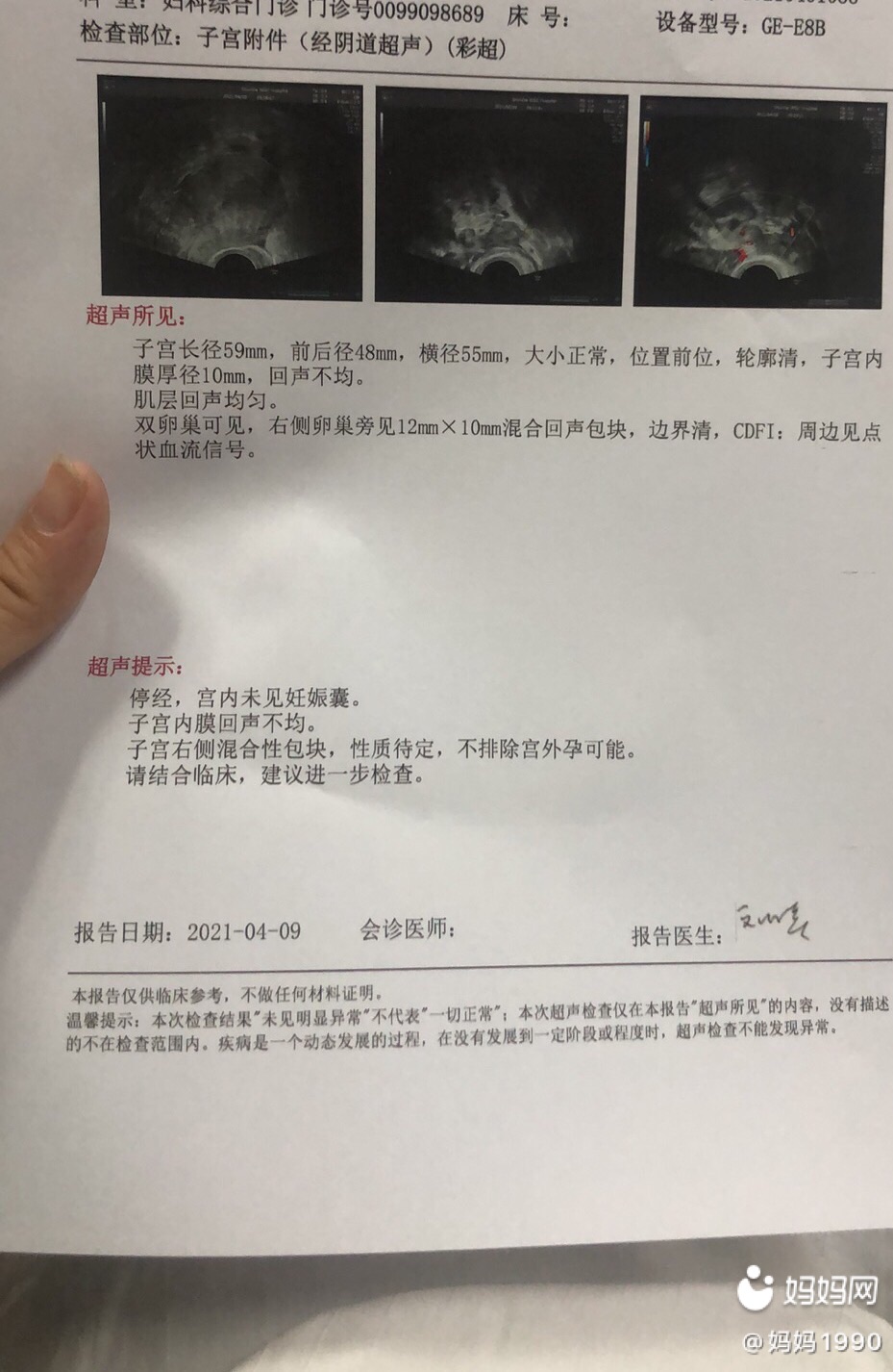 宫内妊娠(宫内妊娠囊样回声,未见卵黄囊及胚芽) 宫内妊娠(宫内妊娠囊样回声,未见卵黄囊及胚芽)